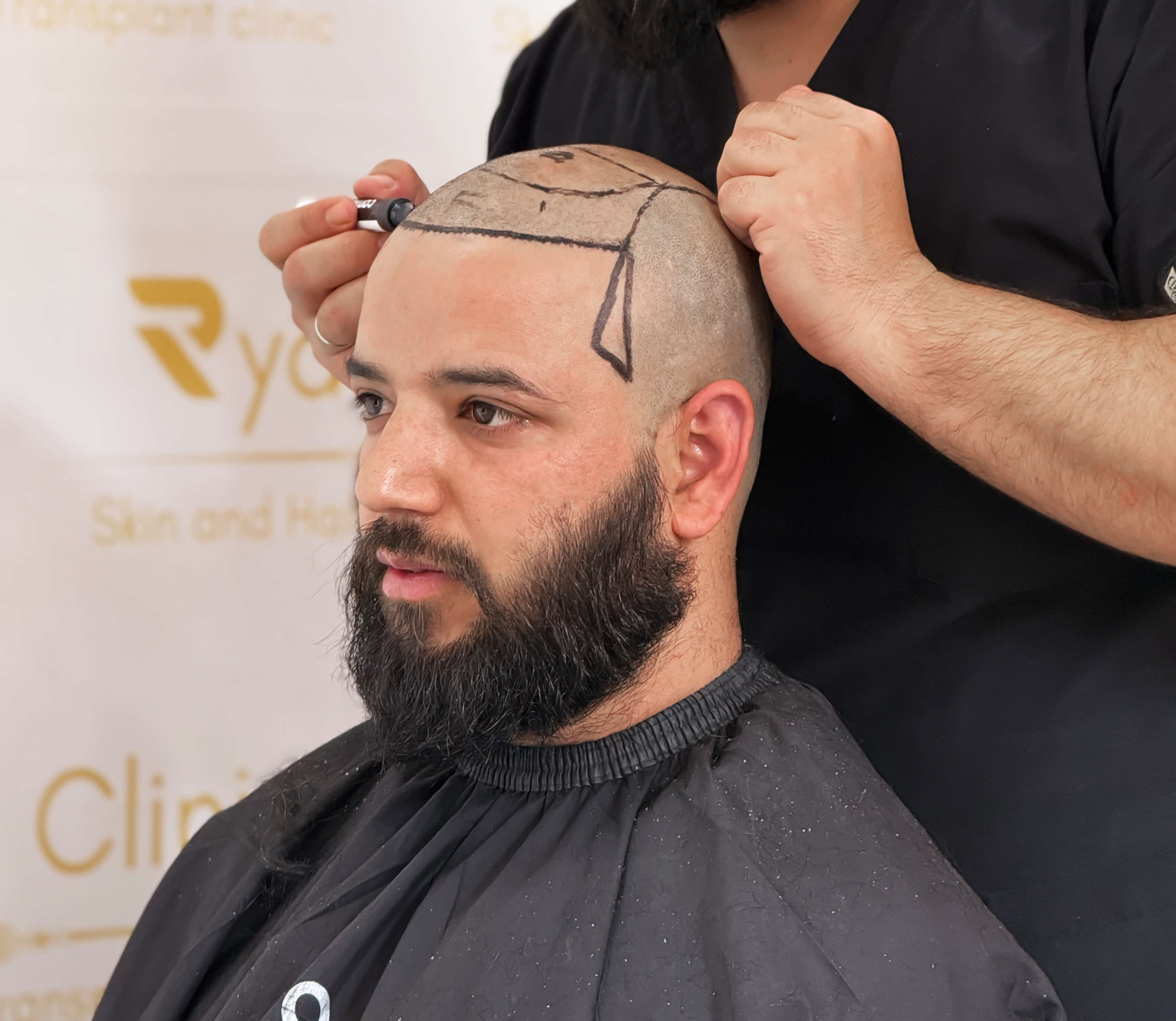 Hair transplant results Mumbai